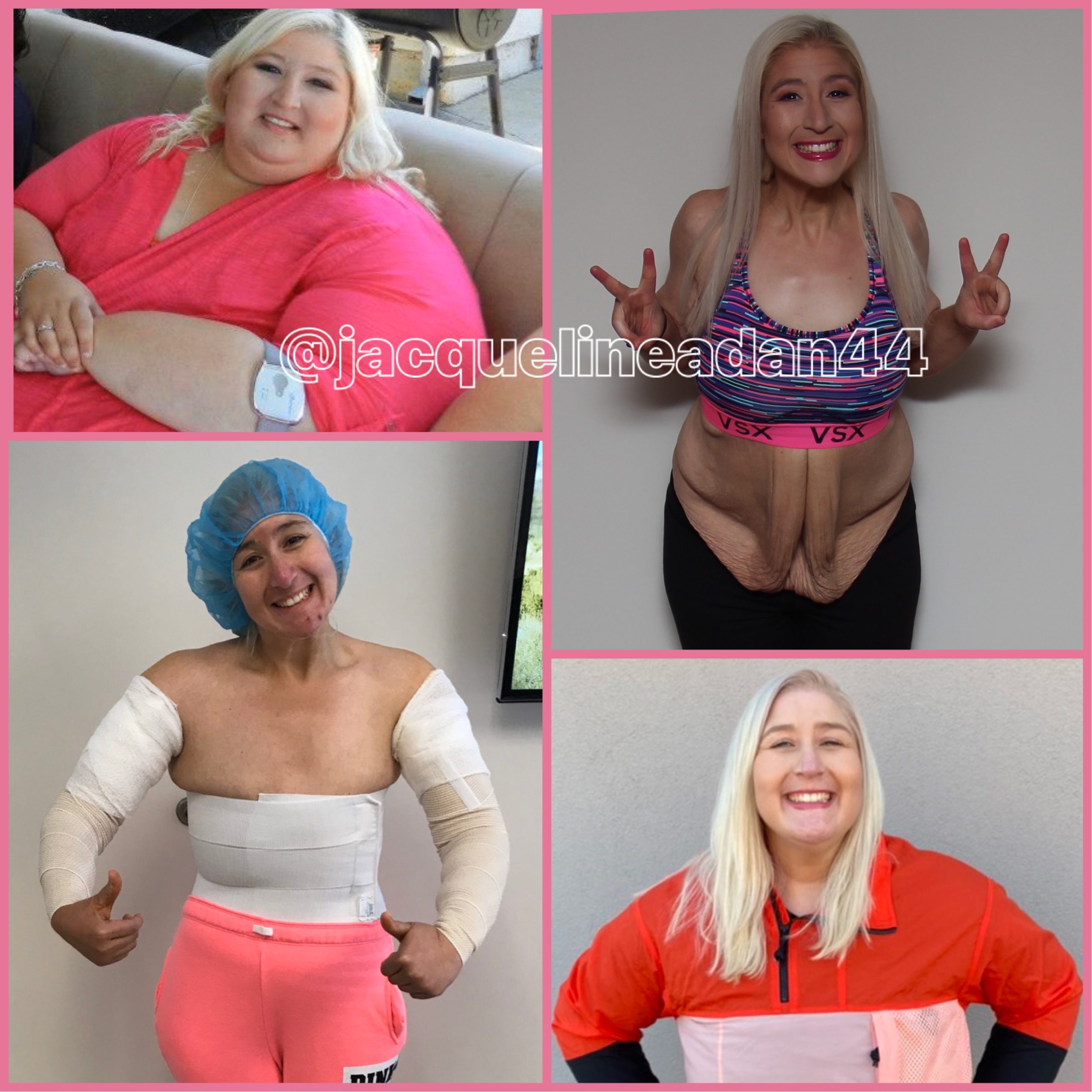 Jacqueline Adan Before and After Weight Loss and Skin Removal
